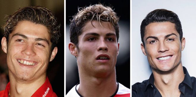 Ronaldo prima e dopo la plastica