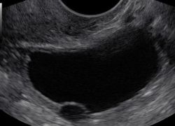 formazione anecogena nell'ovaio