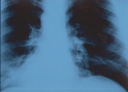 atelettasia della radiografia polmonare