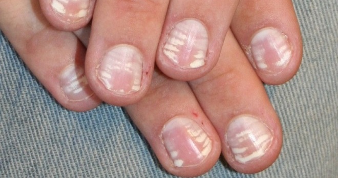 Macchie bianche sulle unghie - cosa segnala il corpo?