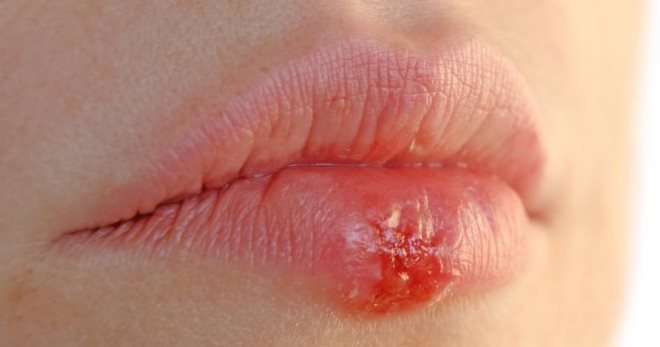 Herpes ant lūpų - priežastis ir greitas gydymas