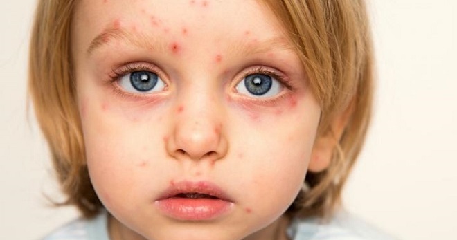 Vaikų herpesas - tipiški viruso tipai, simptomai ir gydymas