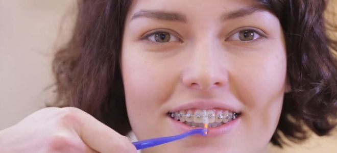 Bagaimana untuk memberus gigi anda dengan berus untuk kurungan terlebih dahulu