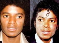 признаки витилиго и красной волчанки на коже Майкла Джексона