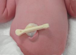 Come trattare l'ombelico di un neonato con una molletta