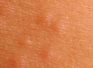 odos bėrimų tipai 6