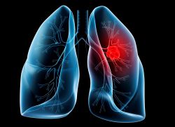 trattamento dei rimedi popolari per il cancro del polmone