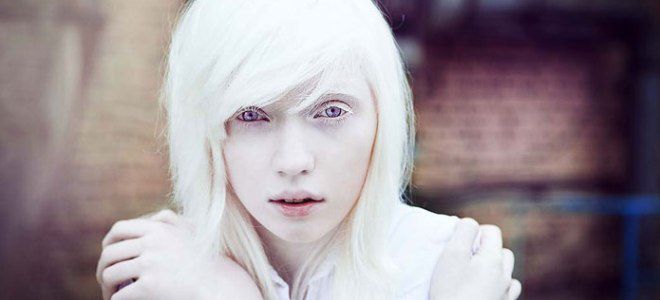 альбинизм у людей