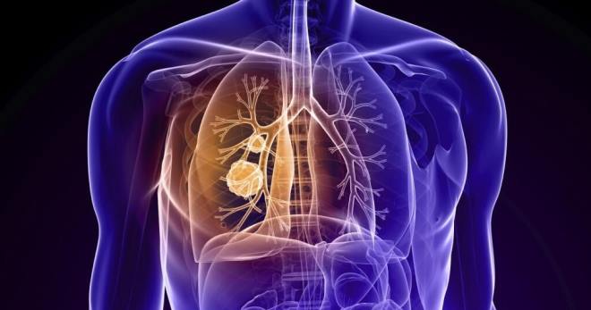 Bronkitis obstruktif - penyebab, rawatan dan ciri penting penyakit