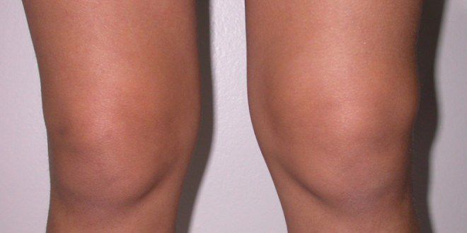 отек ноги в области колена