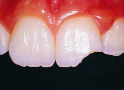 Sekeping gigi anterior terputus