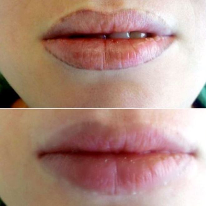 penyingkiran laser bibir bibir (2)