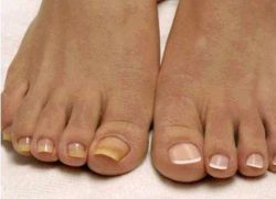 Kojų skausmų nagų storinimas