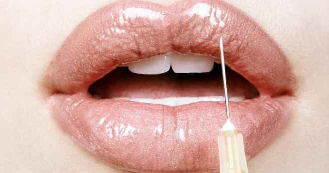 Meningkatkan bibir dengan asid hyaluronik - adakah ia layak untuk menentukan prosedur?
