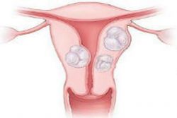 fibroid rahim
