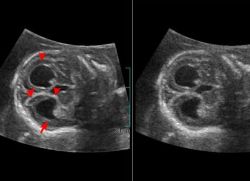 ventricolomegalia nel feto
